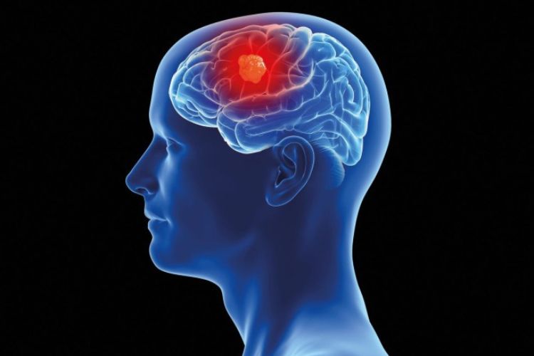 Brain Tumour Misdiagnosis