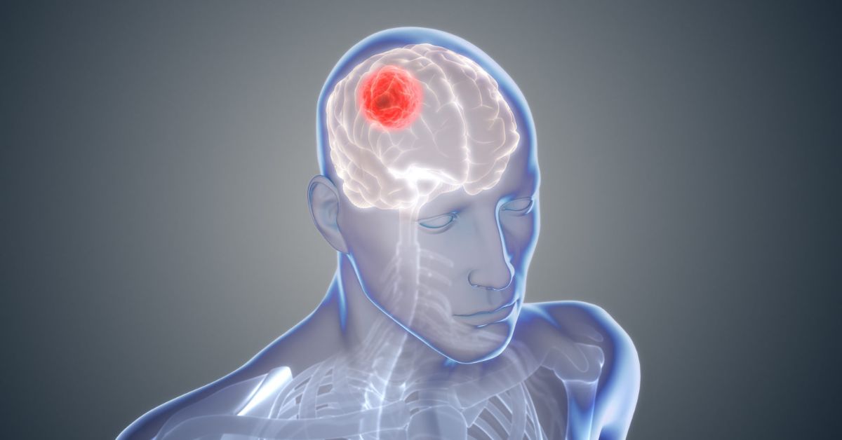 Brain cancer misdiagnosis