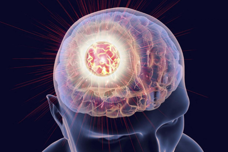 What can be mistaken for a brain tumor